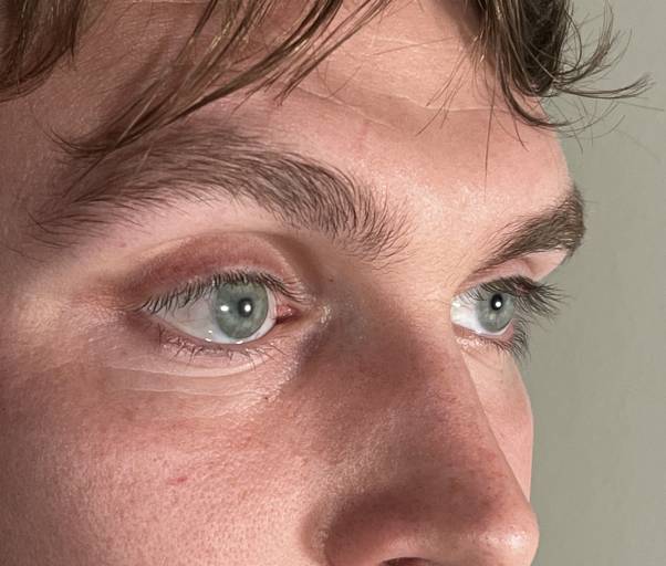 Das künstliche rechte Auge, im Bild links zu sehen, ist kaum vom echten zu unterscheiden: Die mit Technologien des Fraunhofer IGD im 3D-Druckverfahren hergestellten Augenprothesen überzeugen in Erscheinung und Form. 
(Bild: Stephen Bell, Ocupeye Ltd)
