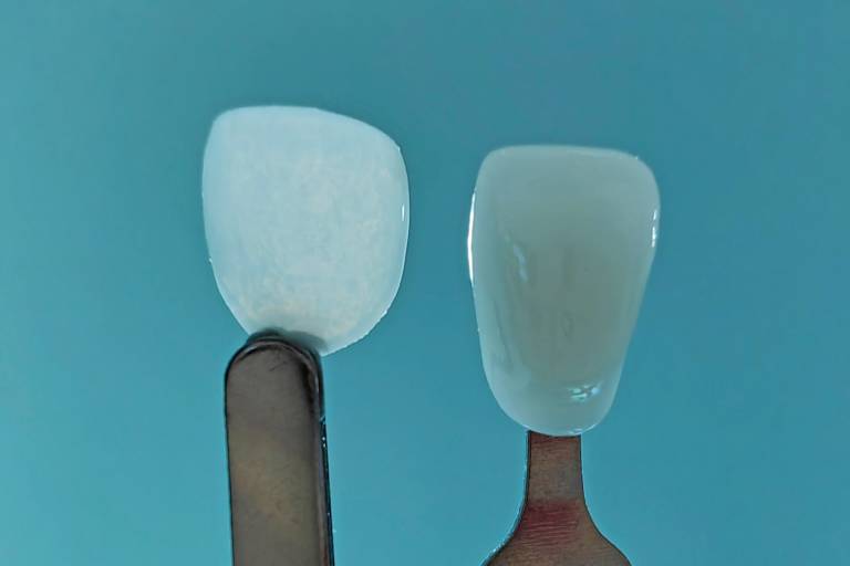 BMF nutzt seine Technologie auf dem Dentalmarkt, um Veneers herzustellen, die dünner und kleiner sind als die derzeit auf dem Markt erhältlichen: links die Ultrathineer-Verblendung aus Zirkoniumdioxid – rechts eine herkömmliche Verblendung.